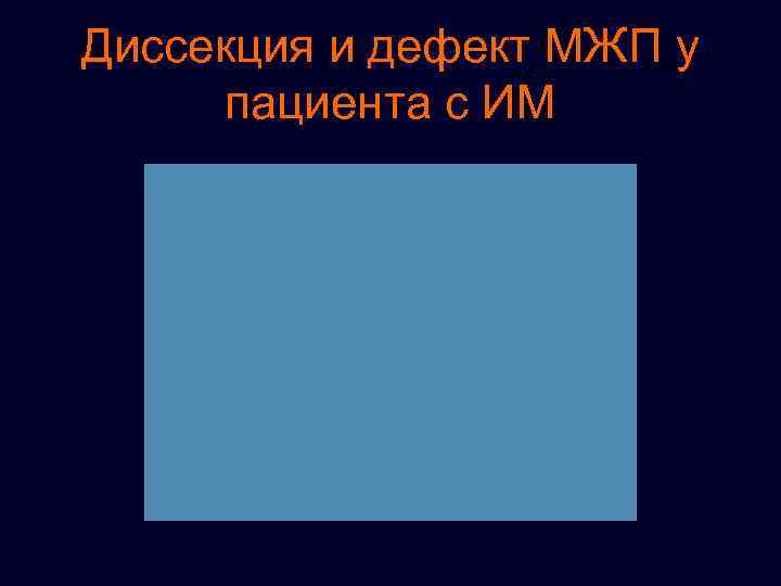 Диссекция и дефект МЖП у пациента с ИМ 