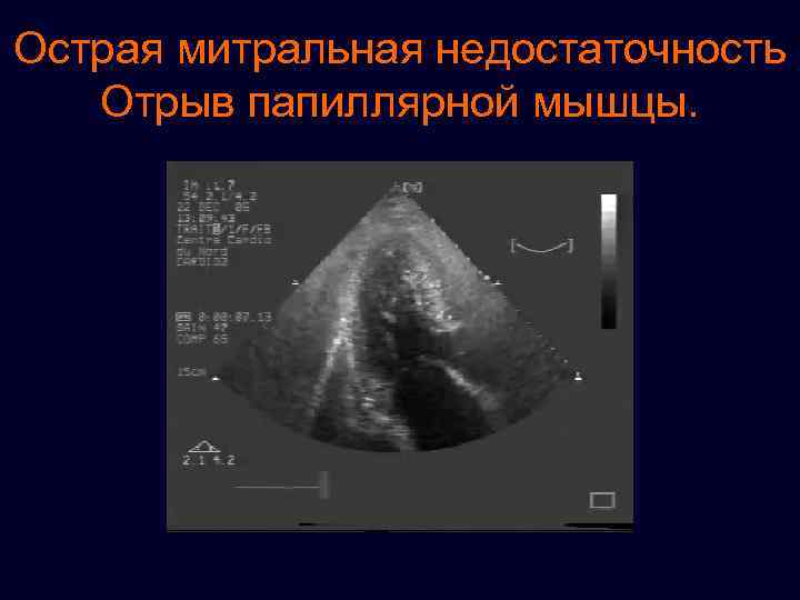Острая митральная недостаточность Отрыв папиллярной мышцы. 