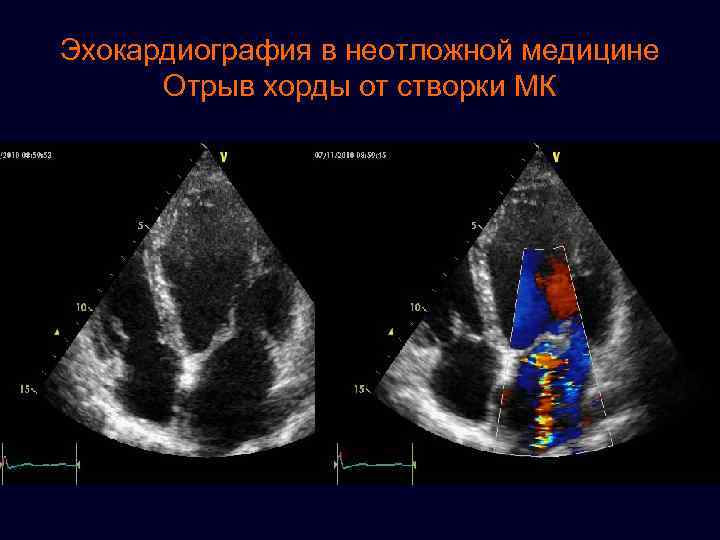 Эхокардиография в неотложной медицине Отрыв хорды от створки МК 