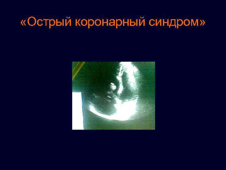  «Острый коронарный синдром» 