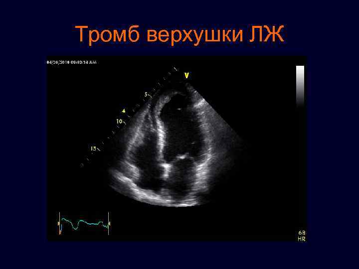Сердечный тромбоз. Тромб верхушки левого желудочка. Аневризма верхушки лж ЭХОКГ. Тромб правого желудочка ЭХОКГ. Тромб в левом желудочке на УЗИ.