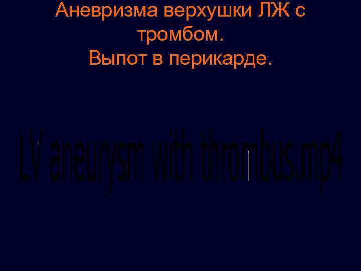 Аневризма верхушки ЛЖ с тромбом. Выпот в перикарде. 