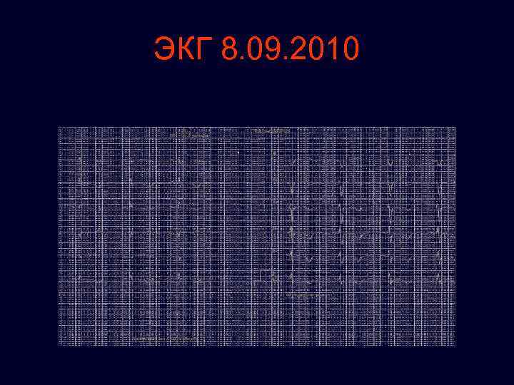 ЭКГ 8. 09. 2010 