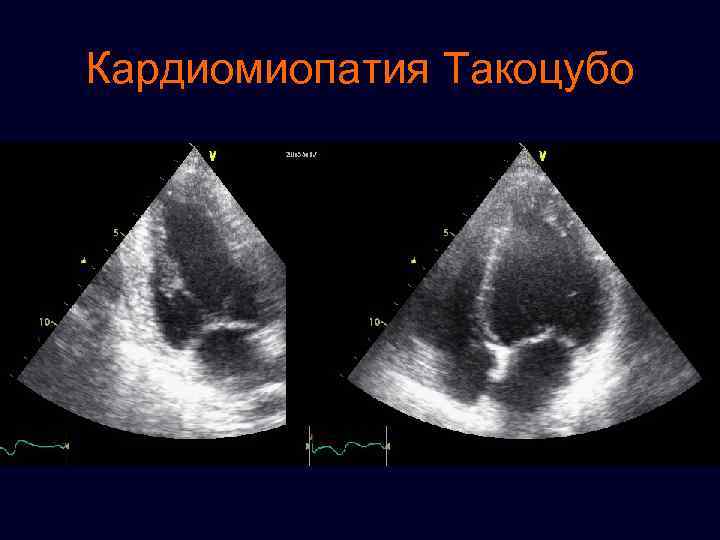 Кардиомиопатия Такоцубо 