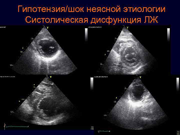 Гипотензия/шок неясной этиологии Систолическая дисфункция ЛЖ 