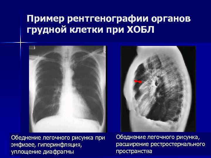 Пример рентгенографии органов грудной клетки при ХОБЛ Обеднение легочного рисунка при эмфизее, гиперинфляция, уплощение