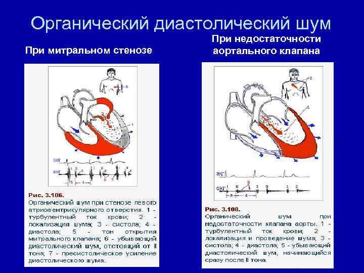 Органический диастолический шум При митральном стенозе При недостаточности аортального клапана 