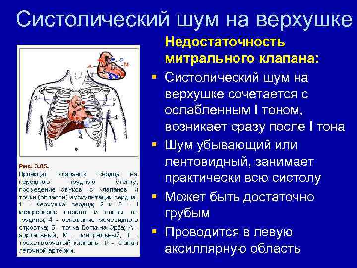 Систолический шум на верхушке § § Недостаточность митрального клапана: Систолический шум на верхушке сочетается