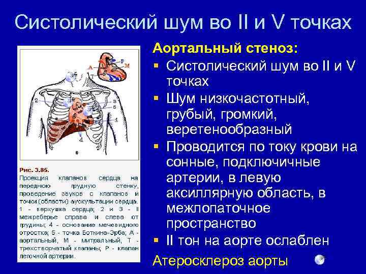 Систолический шум во II и V точках Аортальный стеноз: § Систолический шум во II