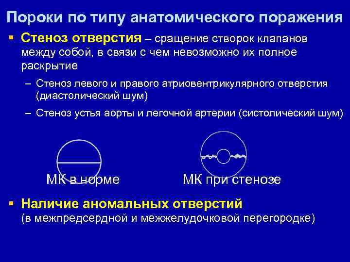 Пороки по типу анатомического поражения § Стеноз отверстия – сращение створок клапанов между собой,
