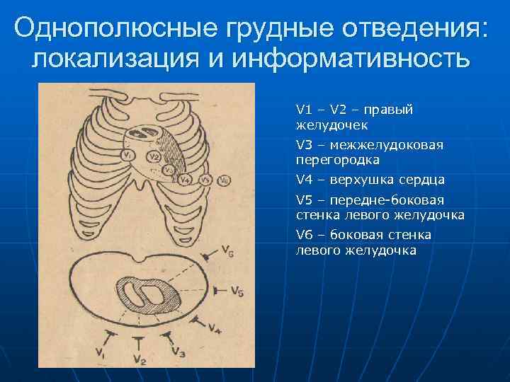 Однополюсные грудные отведения: локализация и информативность V 1 – V 2 – правый желудочек