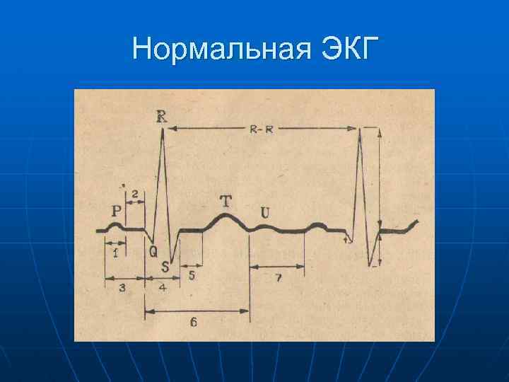 Нормальная ЭКГ 