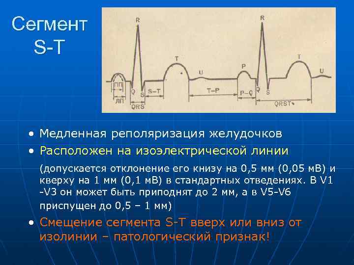 Сегмент S-T • Медленная реполяризация желудочков • Расположен на изоэлектрической линии (допускается отклонение его