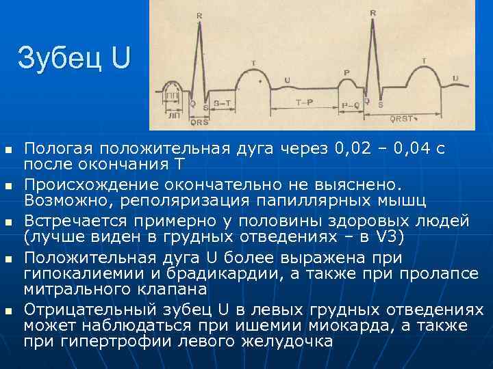 Зубец U n n n Пологая положительная дуга через 0, 02 – 0, 04
