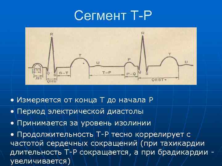 Сегмент Т-Р • Измеряется от конца Т до начала Р • Период электрической диастолы