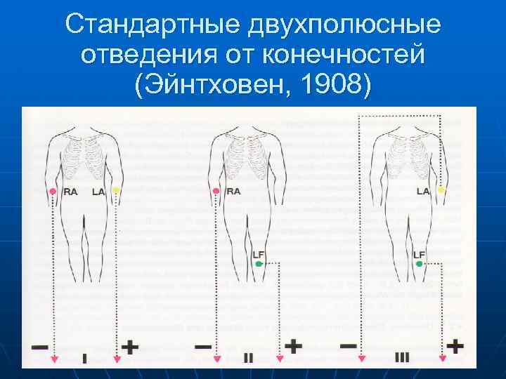 Стандартные двухполюсные отведения от конечностей (Эйнтховен, 1908) 