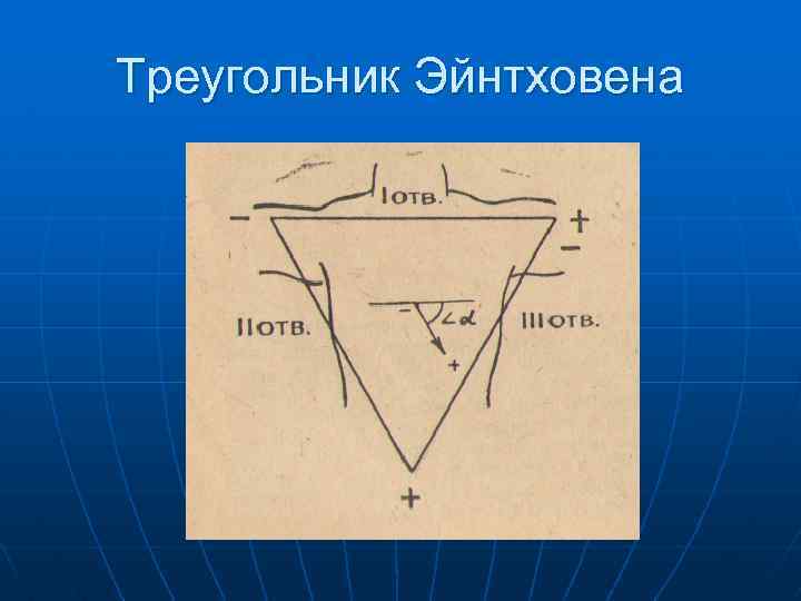 Треугольник Эйнтховена 