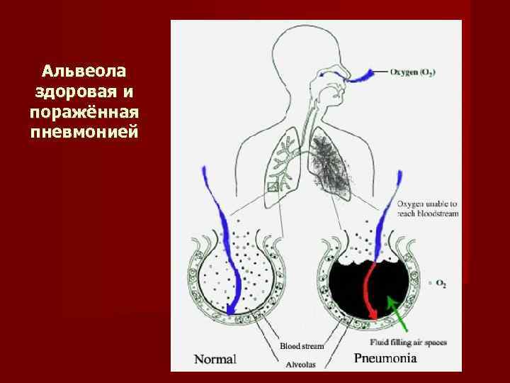 Альвеола здоровая и поражённая пневмонией 