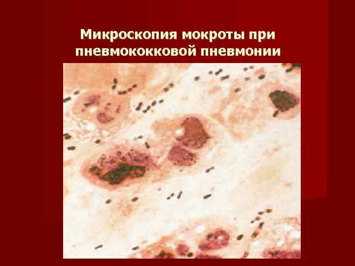 Микроскопия мокроты при пневмококковой пневмонии 