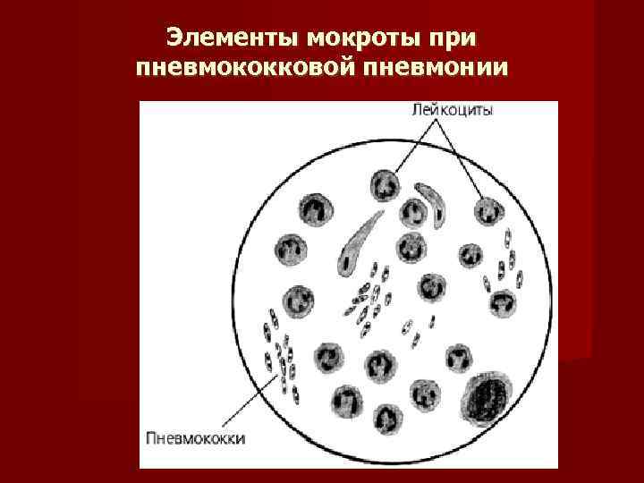 Элементы мокроты при пневмококковой пневмонии 