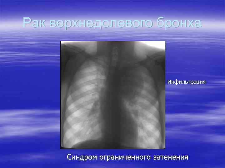 Рак верхнедолевого бронха Инфильтрация Синдром ограниченного затенения 