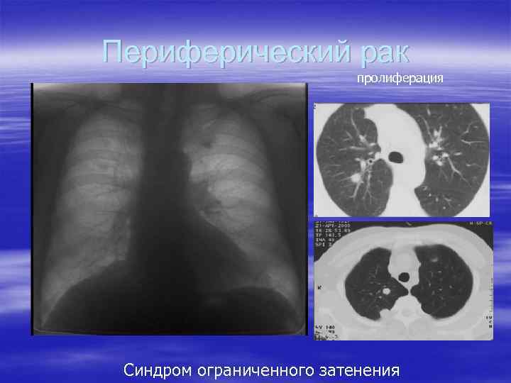 Периферический рак пролиферация Синдром ограниченного затенения 