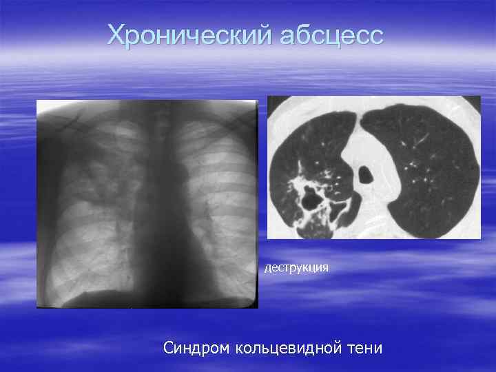 Хронический абсцесс деструкция Синдром кольцевидной тени 