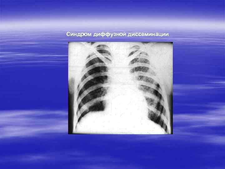 Синдром диффузной диссеминации 