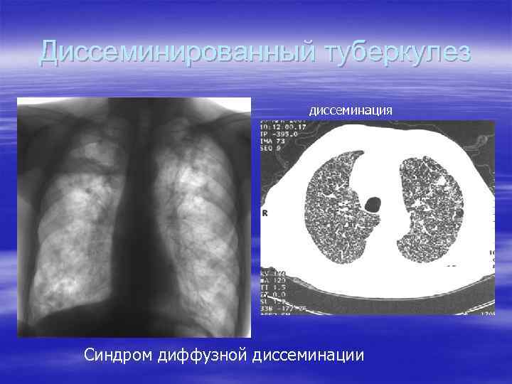 Диссеминированный туберкулез диссеминация Синдром диффузной диссеминации 