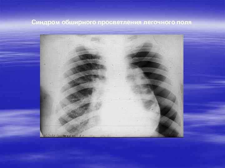 Синдром обширного просветления легочного поля 