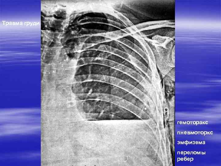 Травма груди гемоторакс пневмоторкс эмфизема переломы ребер 