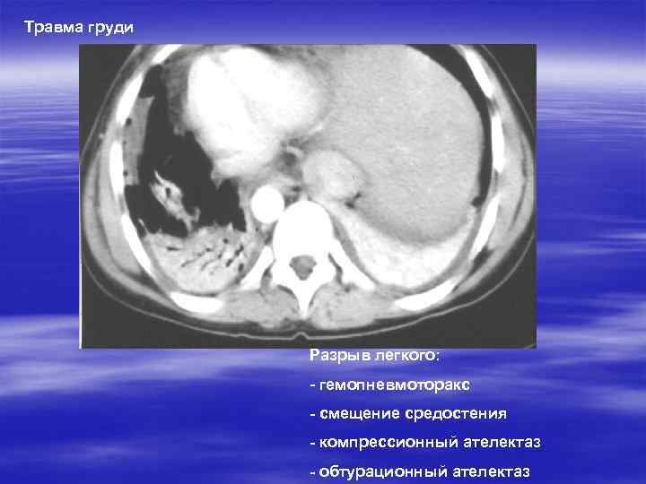 Травма груди Разрыв легкого: - гемопневмоторакс - смещение средостения - компрессионный ателектаз - обтурационный