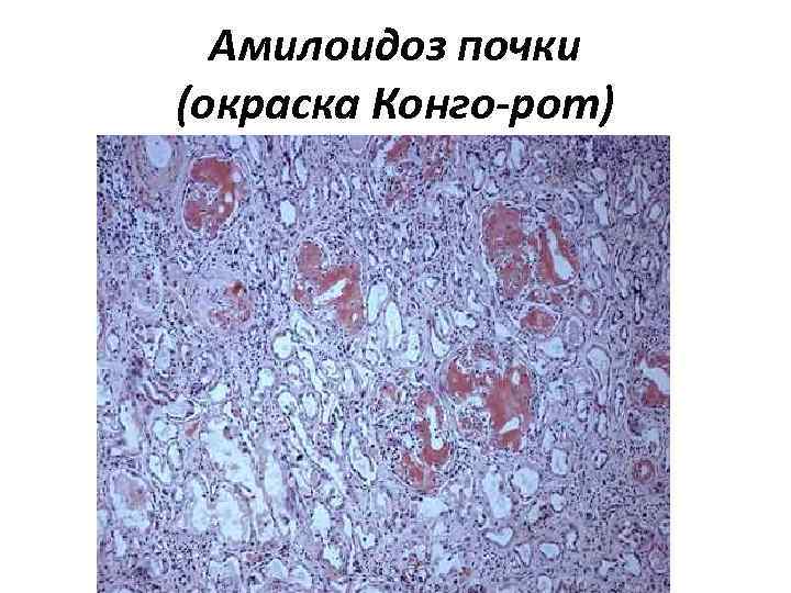 Амилоидоз почки (окраска Конго-рот) 