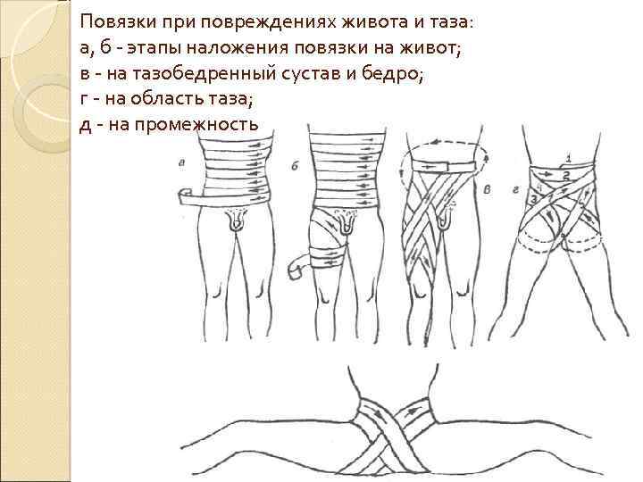 Повязки при повреждениях живота и таза: а, б - этапы наложения повязки на живот;