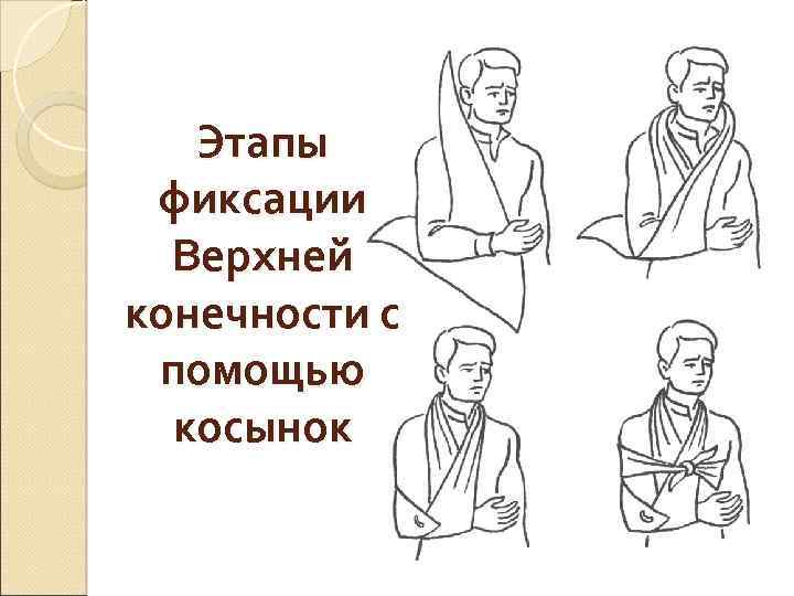 Этапы фиксации Верхней конечности с помощью косынок 