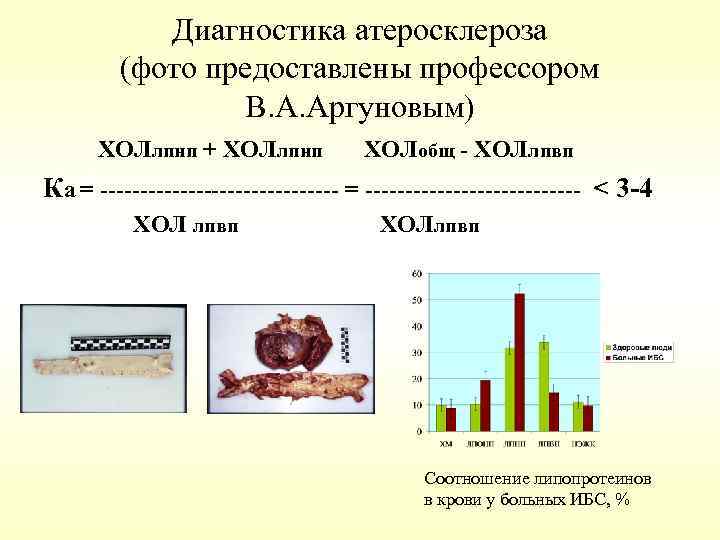 Диагностика атеросклероза (фото предоставлены профессором В. А. Аргуновым) ХОЛлпнп + ХОЛлпнп ХОЛобщ - ХОЛлпвп
