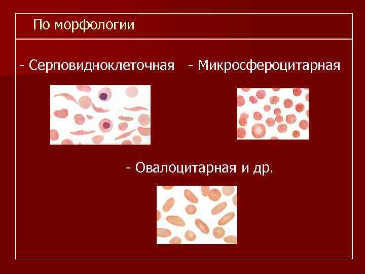 По морфологии - Серповидноклеточная - Микросфероцитарная - Овалоцитарная и др. 