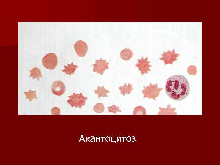 Акантоцитоз 