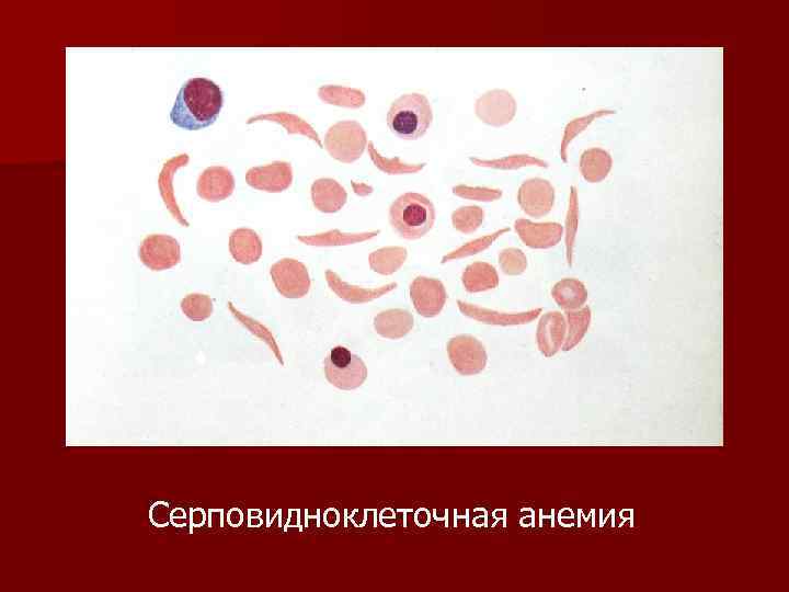 Серповидноклеточная анемия 