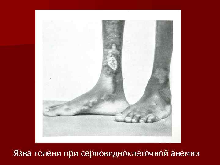 Язва голени при серповидноклеточной анемии 