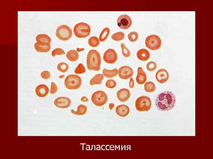 Талассемия 
