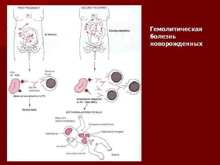 Гемолитическая болезнь новорожденных 