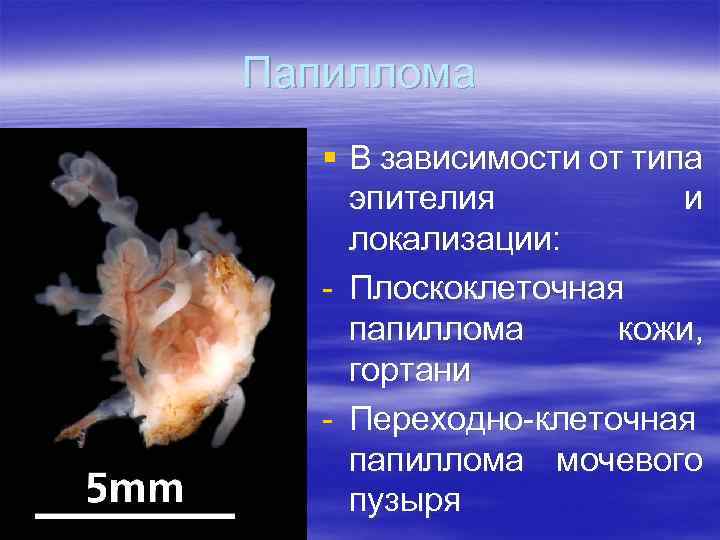 Папиллома § В зависимости от типа эпителия и локализации: - Плоскоклеточная папиллома кожи, гортани