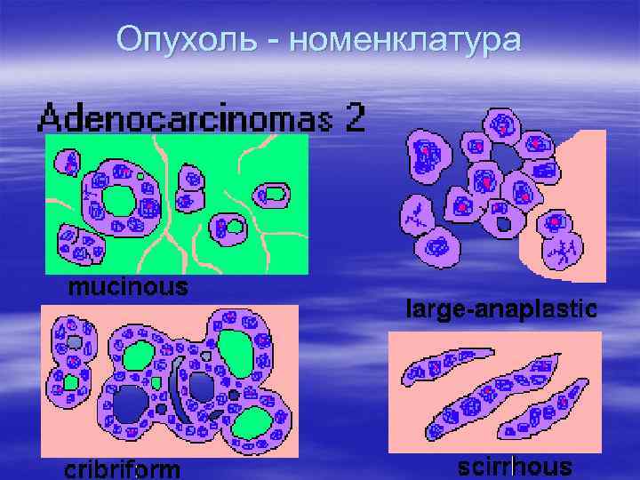 Опухоль - номенклатура 