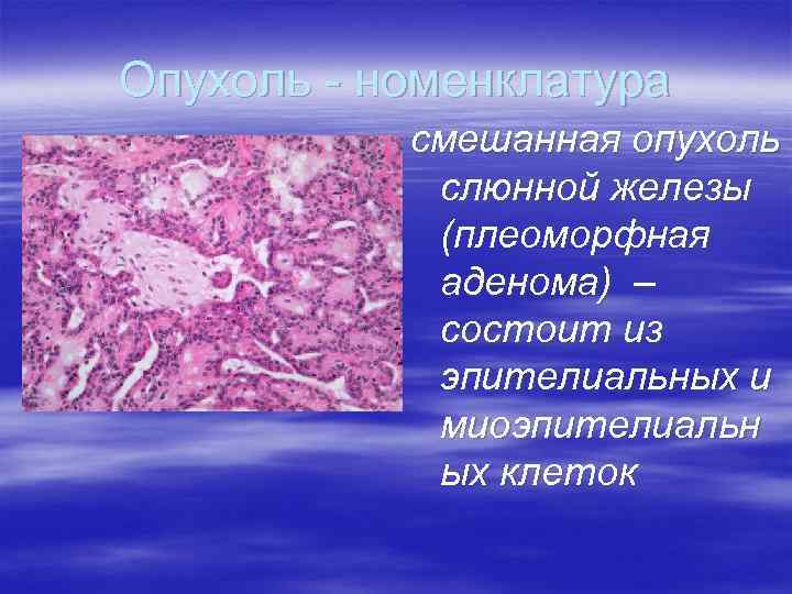 Опухоль - номенклатура смешанная опухоль слюнной железы (плеоморфная аденома) – состоит из эпителиальных и