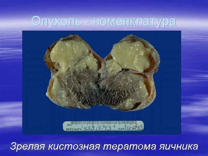 Опухоль - номенклатура Зрелая кистозная тератома яичника 