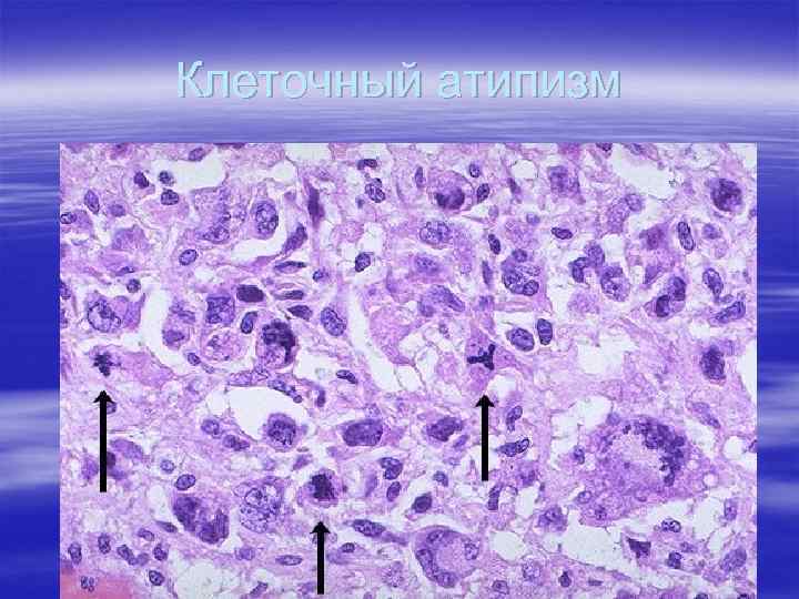 Клеточный атипизм 