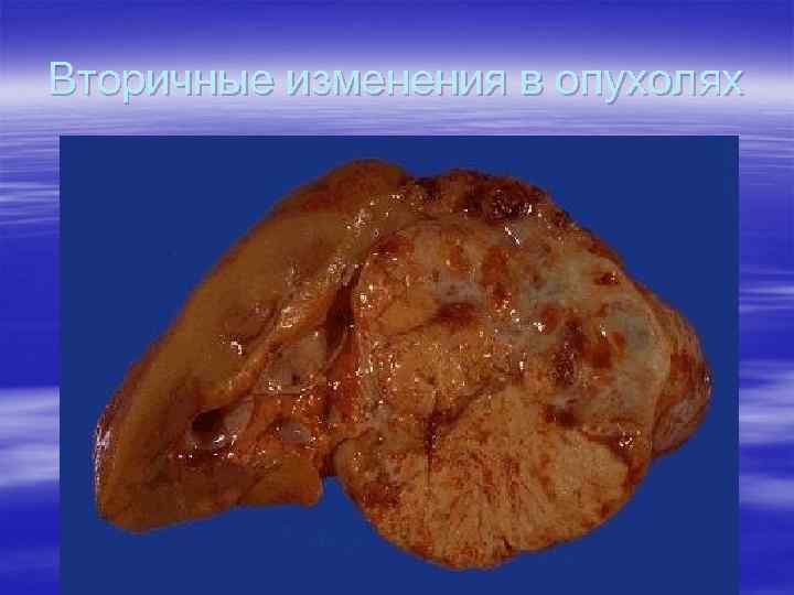 Вторичные изменения в опухолях 