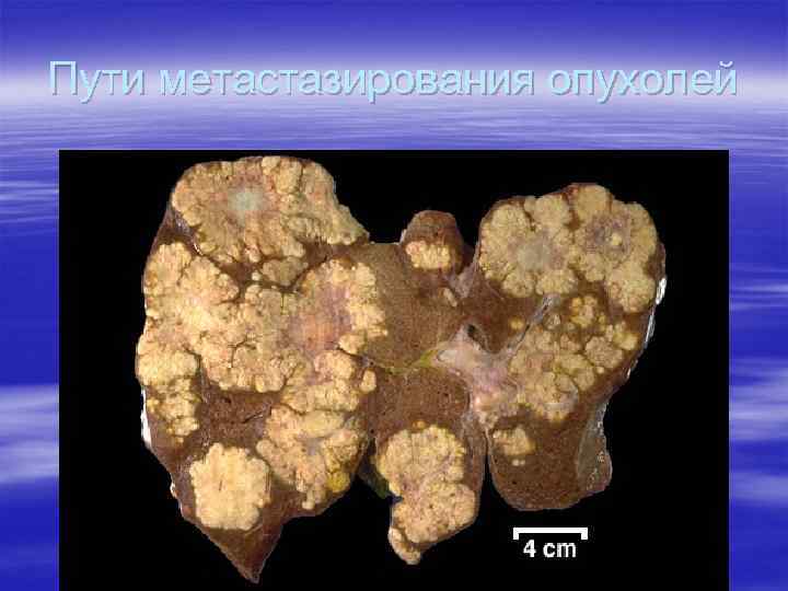 Пути метастазирования опухолей 