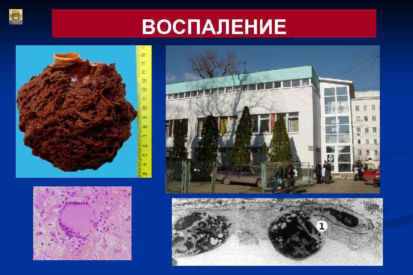 ВОСПАЛЕНИЕ 